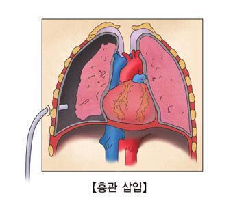 출저는 아산병원꺼 이게 흉관 삽입