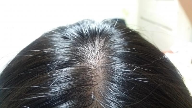 머리 빠질 때마다 마음 아파 죽겠음 이제 20살인데