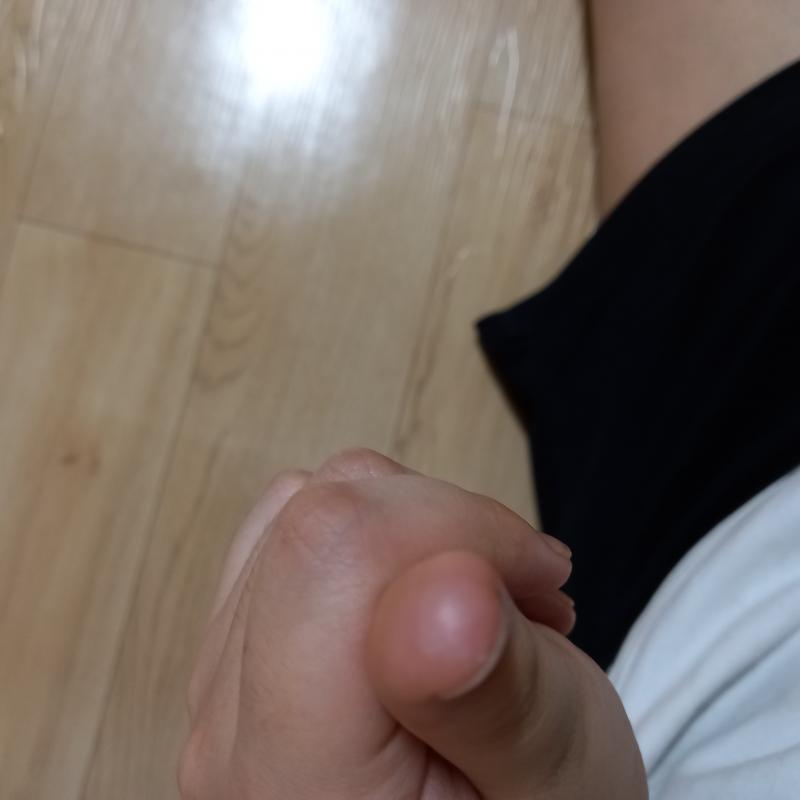 엄지 손꾸락이야ㅜㅜ