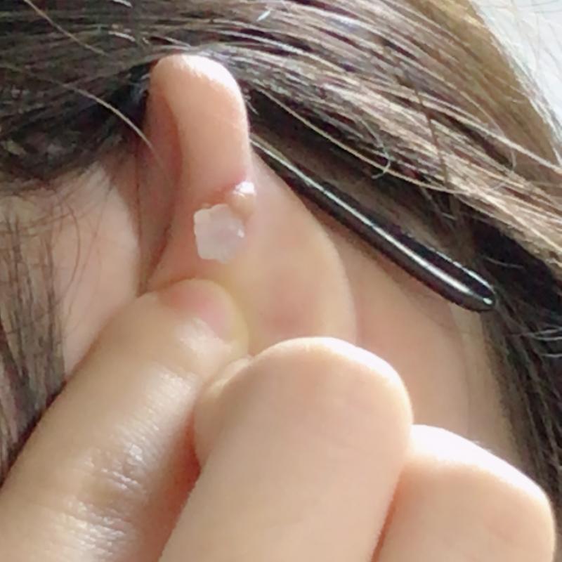 고름 빼기전에는 이랬어ㅠ