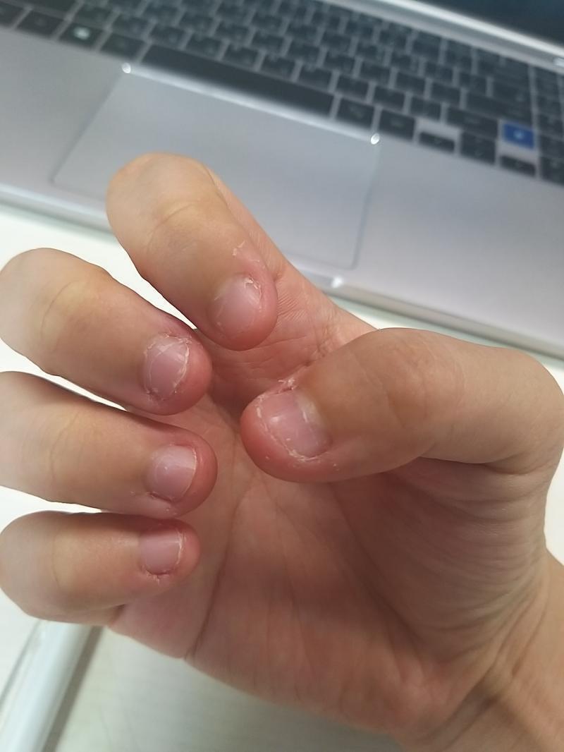 오늘도 왔지요 이건 오른손인데 왼손보다 오른손이 더 심하길레 오른손으로가져오는거야