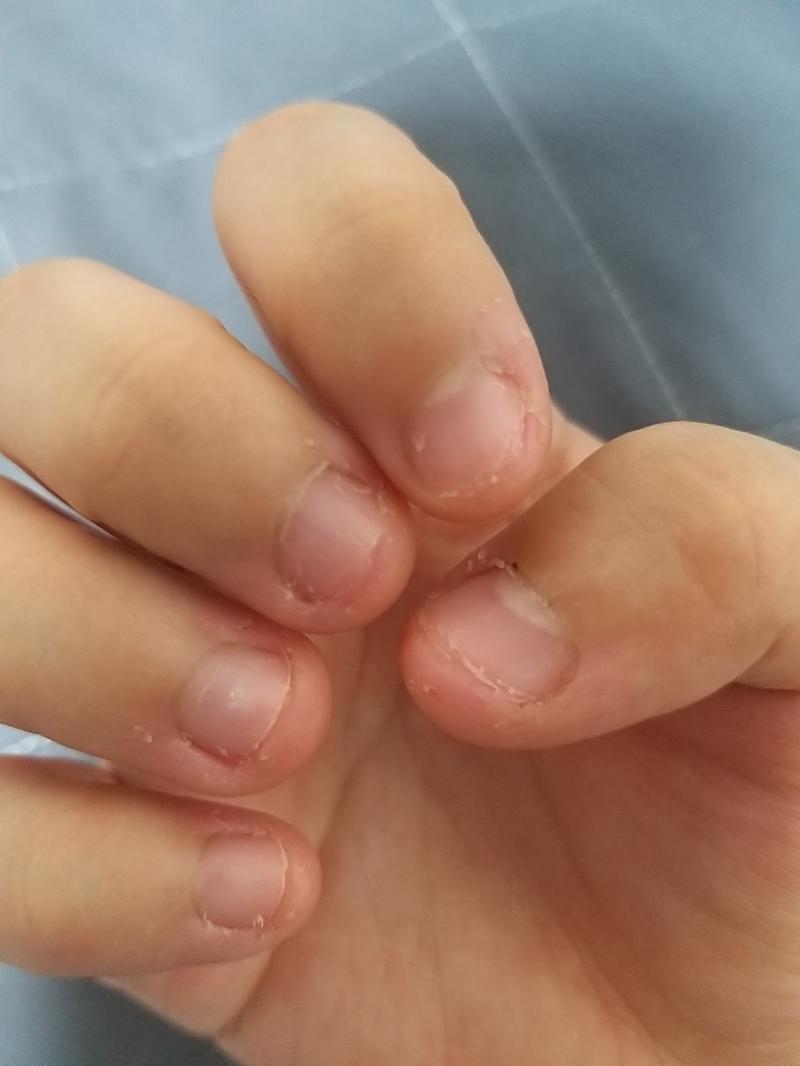 젠장 초점이 안잡힌다ㅠ 깍지 끼고 있으니까 정말 괜찮더라! 계속 뜯어왔던 손톱이라 자라는게 더딘가 싶어.. 오늘은 딱히 적을 말이 없는 것 같네