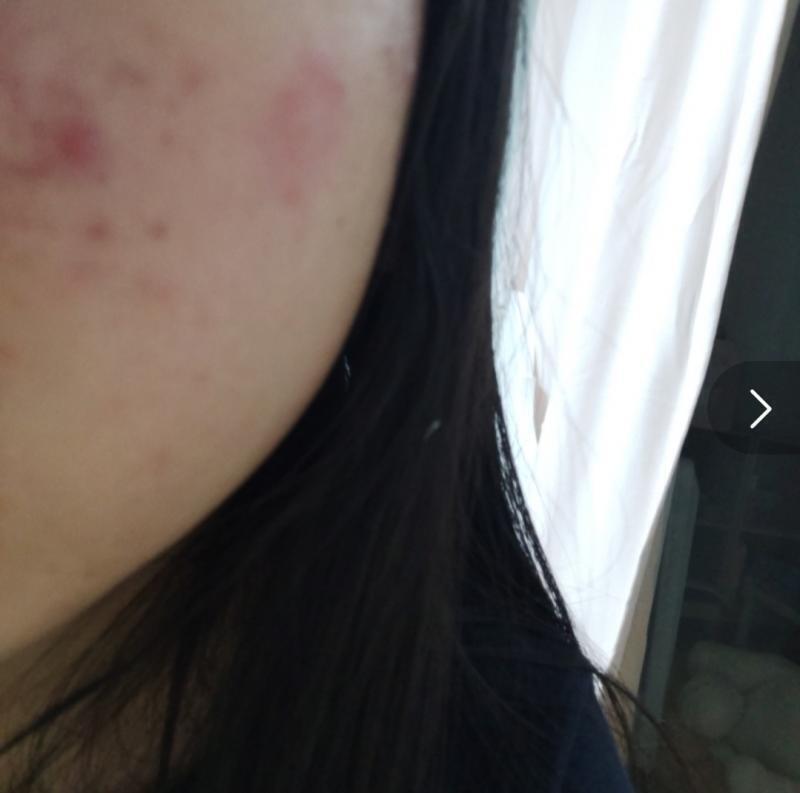 나 3번 레스준데 진짜 ㄹㅇㄹ 피부과 가ㅠㅠㅠ크림이나 앰플들 솔직히 써보기 전까진 모르잖아 맞는거 찾는다고 돈 날리고 이럴바엔 진짜 피부과 가는
