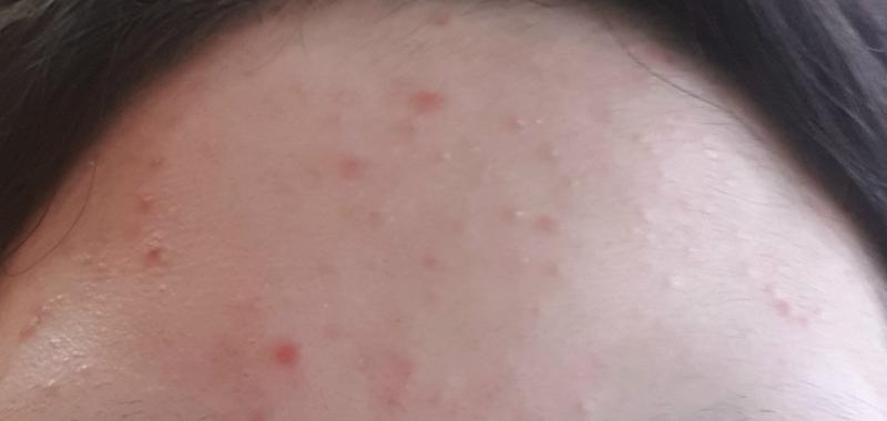 맨날 파데로 가리고 다니다 문득 현타와서 수딩젤 듬뿍바르고 물 하루 2L 마시며 방학동안 관리하기로함 열람 주의 혐오