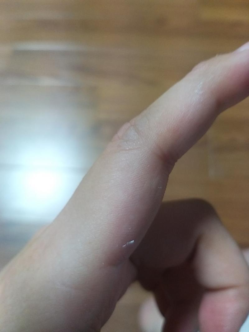 근데 손에 살갗이 얇게 벗겨지는데 왜이러는지 알아? 신경쓰이네,,