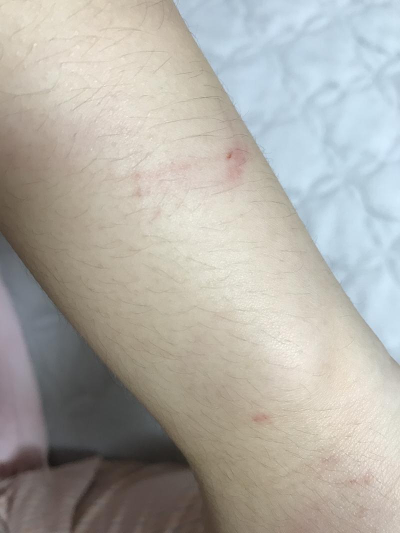 ㅠ 실제로 보면 뭔가 더 피멍스럽고 갈고리로 긁힌 자국느낌이여