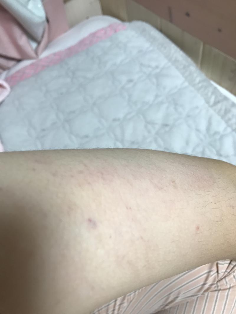 ㅠ 실제로 보면 뭔가 더 피멍스럽고 갈고리로 긁힌 자국느낌이여