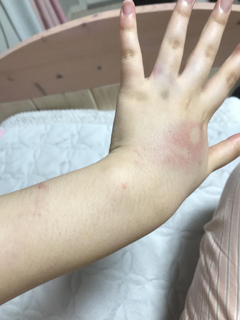 ㅠ 실제로 보면 뭔가 더 피멍스럽고 갈고리로 긁힌 자국느낌이여