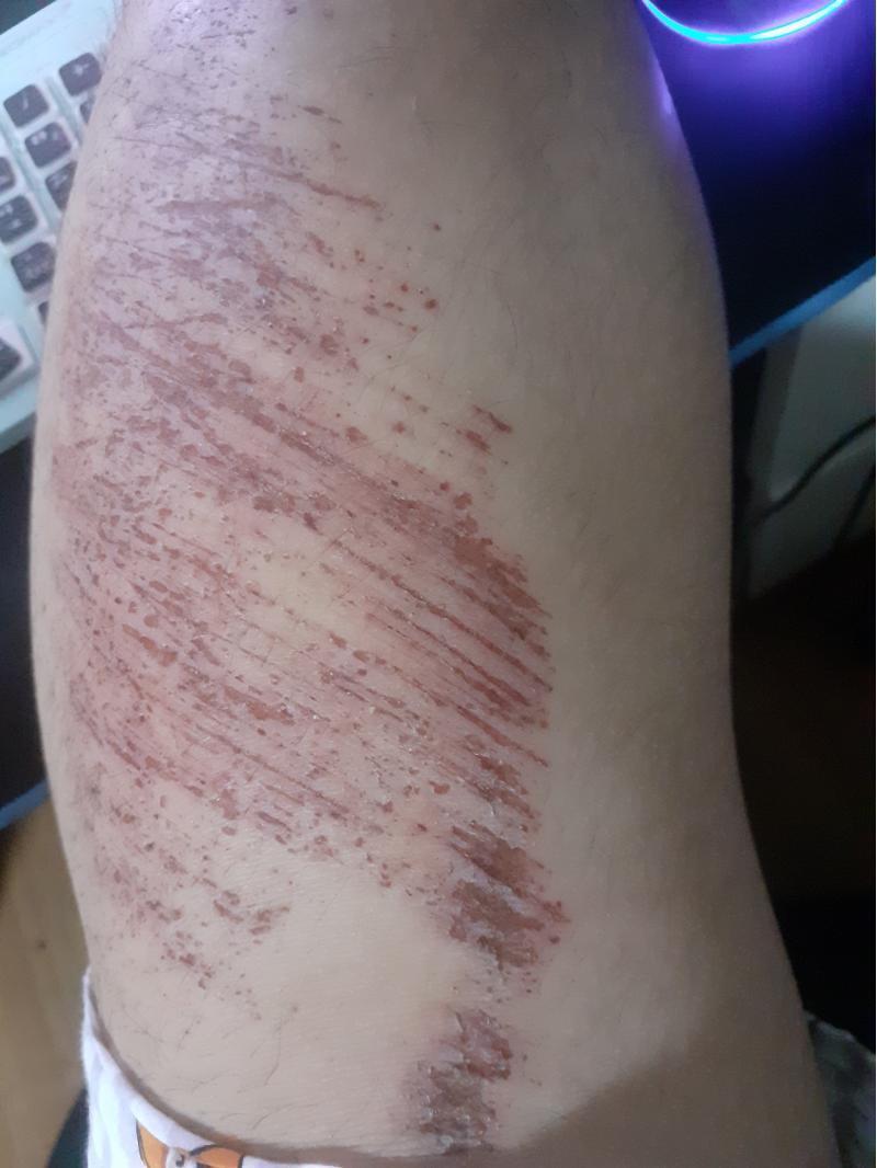 이정도로 다쳐본사람 있어? 사진주의