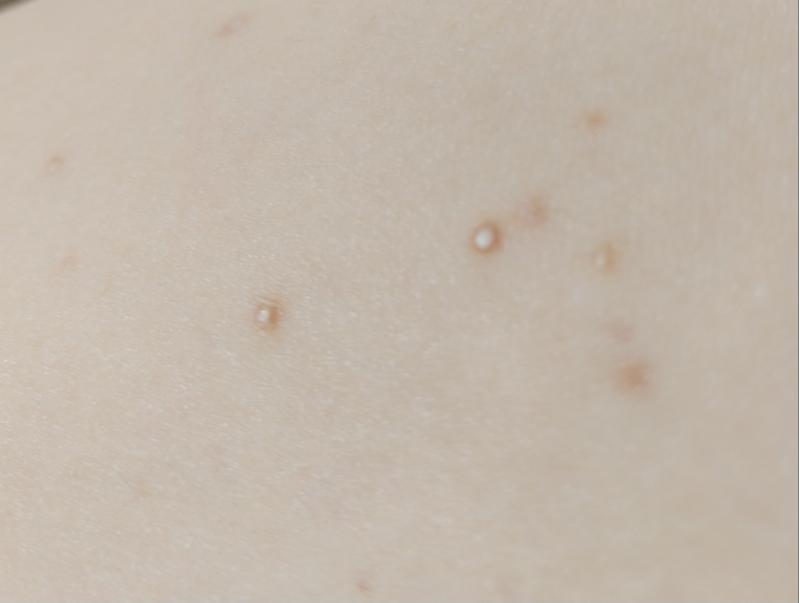 어제 발견했는데 내 다리에 좁쌀같은 것들이 있더라구 그래서 여드름인가? 해서 뜨듯한 수건으로 제거하는 방법을 해봤는데 안되더라구 온도가 낮았던건