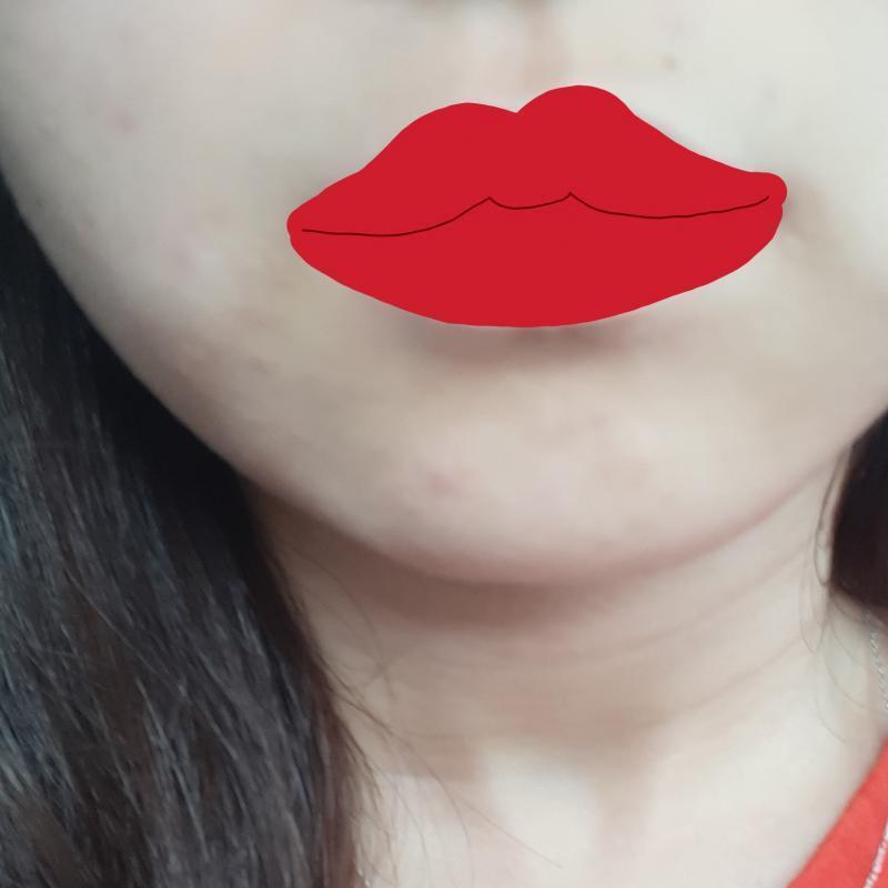 20대 초반이고 곧 중반인데 여드름 왜케 계속 나는거야..ㅎ.. 이마는 거의 좁쌀이고 얼굴 양쪽 측면에 좀 큰게 많이 나는 편ㅠ 턱이랑 입 주변
