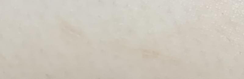 첫 번째는 예시고 두 번째가 내 팔에 있는 건데 고양이한테 긁혀서 저렇게ㅜ됐거든 근데 한 달 넘도록 안 없어져 ㅠㅠ >>2 올렸어 ㅠ