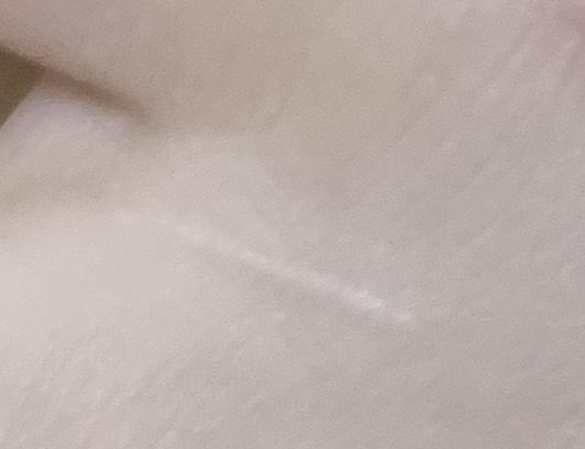 첫 번째는 예시고 두 번째가 내 팔에 있는 건데 고양이한테 긁혀서 저렇게ㅜ됐거든 근데 한 달 넘도록 안 없어져 ㅠㅠ >>2 올렸어 ㅠ