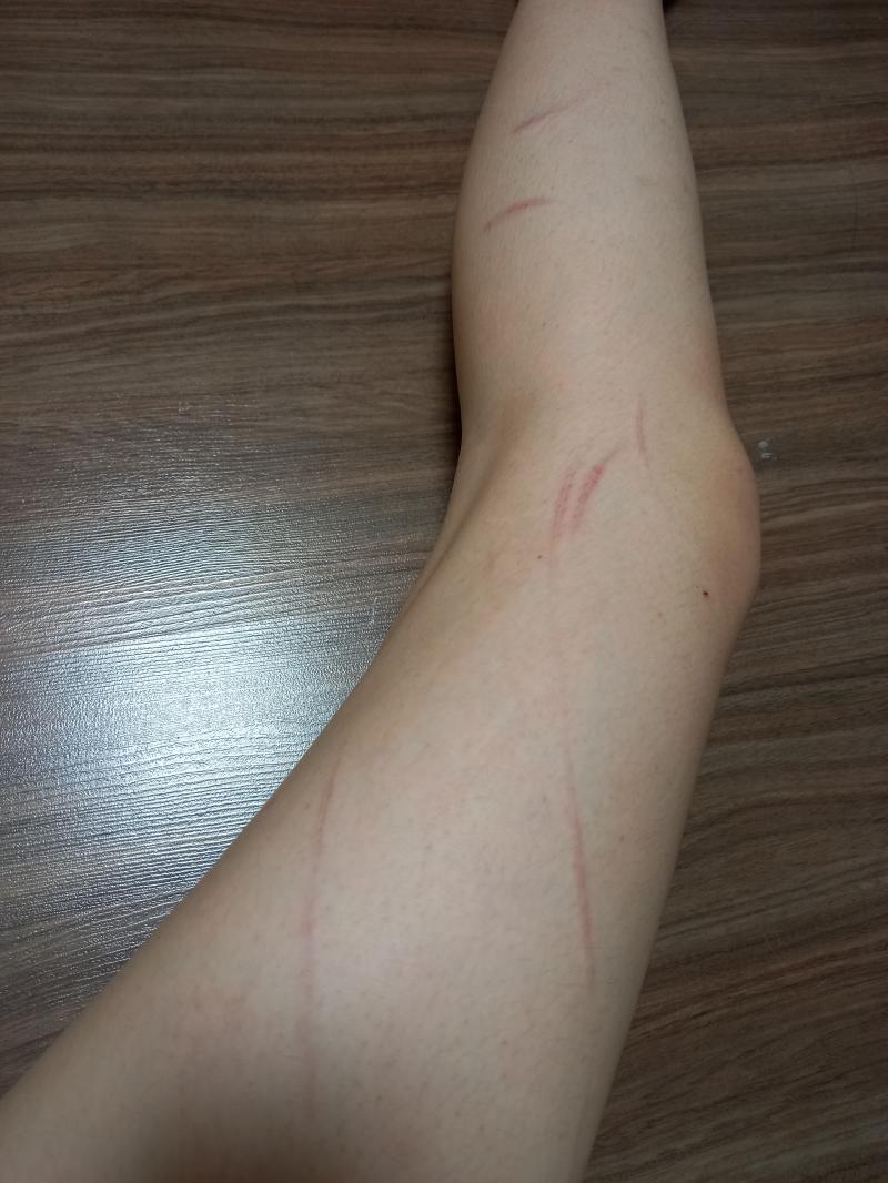 ㅠㅜㅡㅠ하 아직도 쓰라리다 쓰z1r파.....여기말고도 상처 군데군데 있긴한데 키우는 개가 아니라 내가 사람한테 이빨로 물릴줄알앗겟냐고