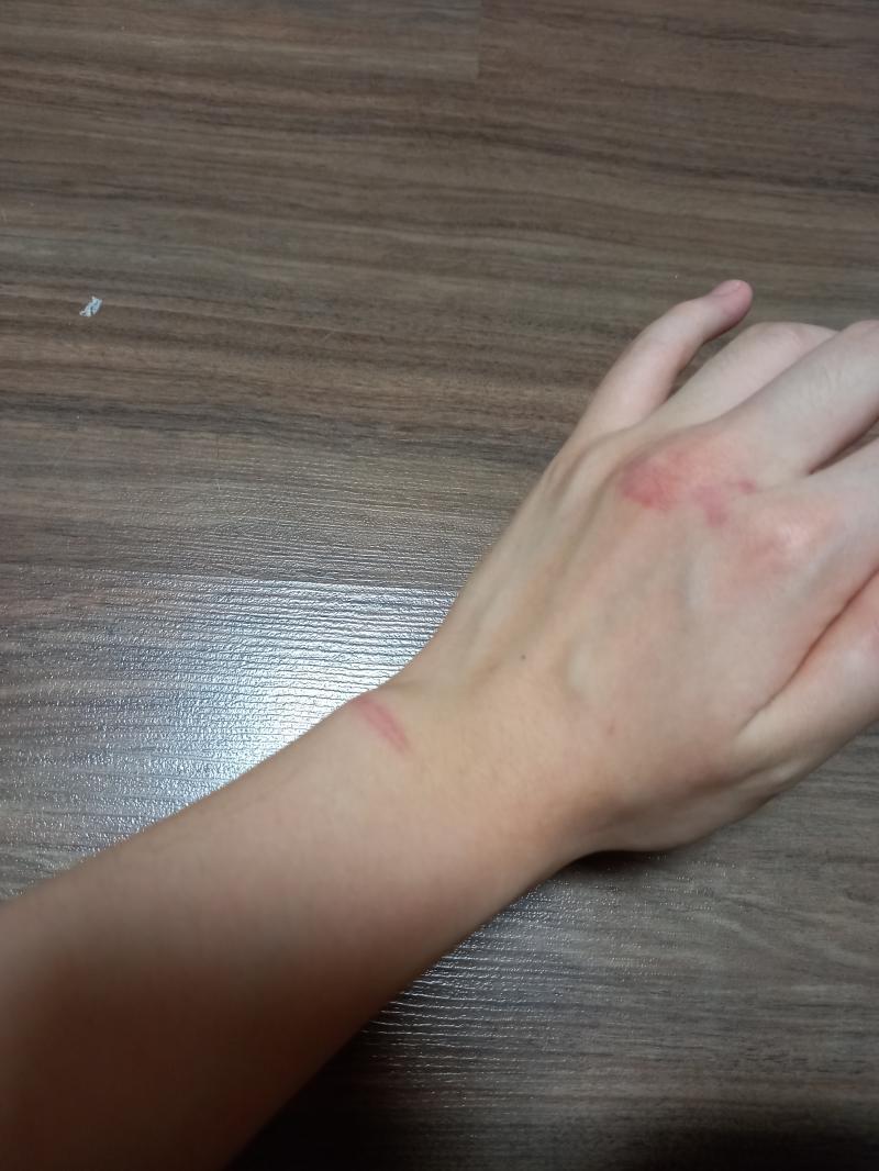 ㅠㅜㅡㅠ하 아직도 쓰라리다 쓰z1r파.....여기말고도 상처 군데군데 있긴한데 키우는 개가 아니라 내가 사람한테 이빨로 물릴줄알앗겟냐고