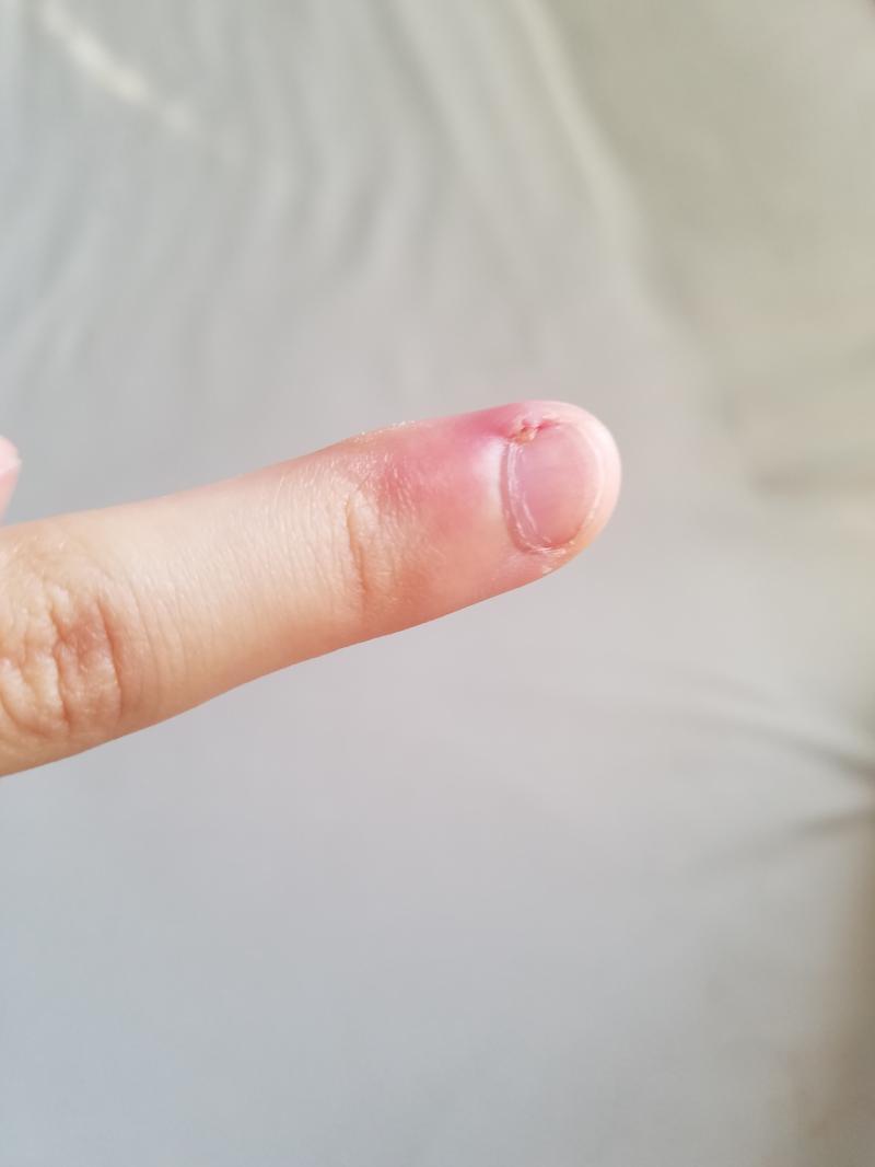 진짜 존나 아파ㅠㅠㅠ