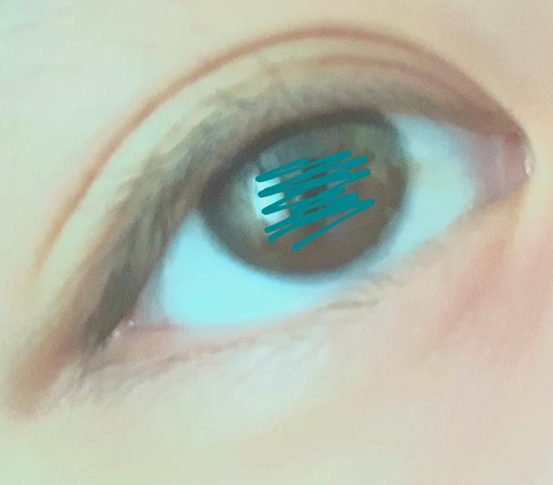 으악 안검하수 오져