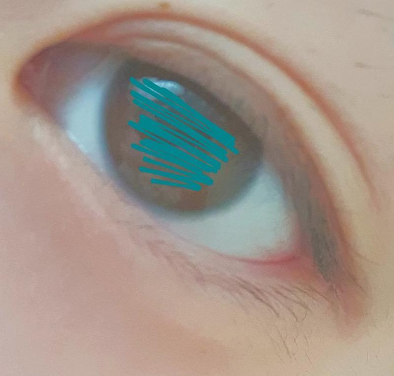반대눈