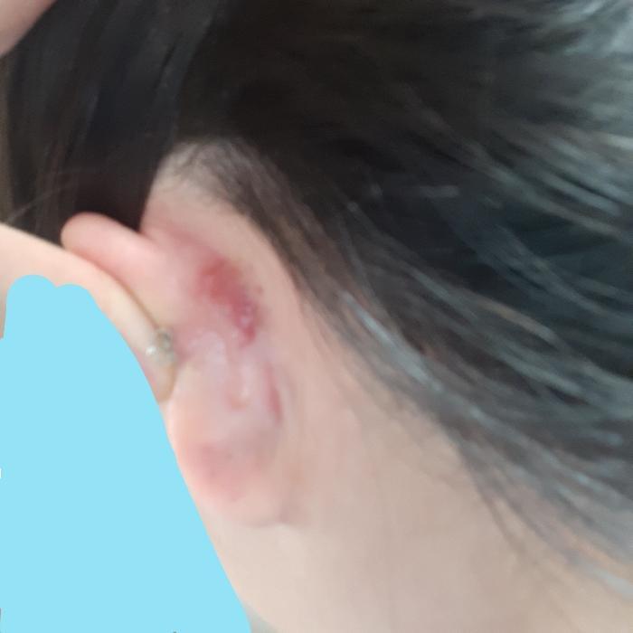 머리에 하얀 거는 진물이 머리에 묻어서 굳은 거.. ※약혐