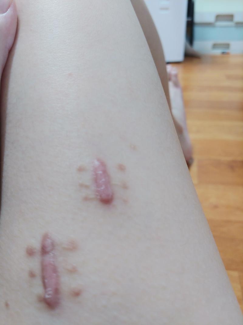 수술 흉터가 많이 나아진거 같네 어 수술 흉터 관리는 11월 부터 가능하던 걸로 아는데