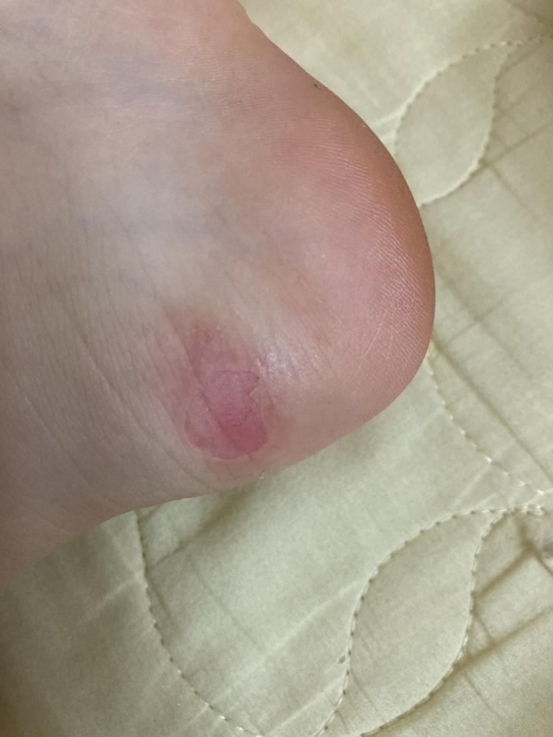 처참한 내 발... 이거 보기엔 이래도 진짜 따가워 미침