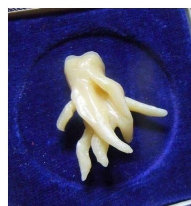 수줍.. 안 아플거야 걱정마 좀 아프다 싶을 때가 지나면 뺄 수 있어