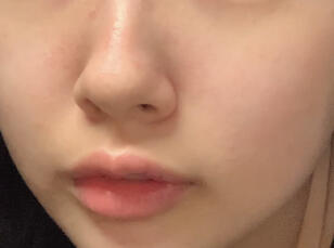 이건 1~2주전 내 볼따구들 상태임 1,2번째는 밤에 찍은거고 마지막은 낮에 찍은거야