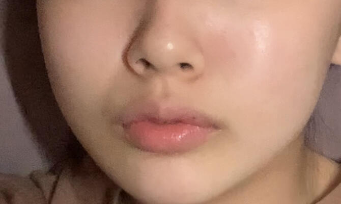 이건 1~2주전 내 볼따구들 상태임 1,2번째는 밤에 찍은거고 마지막은 낮에 찍은거야