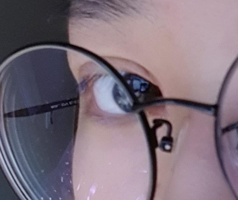 약간 싼데서 해서 그런가 앞부분두 뽈록하고 딱딱?하고 울퉁불퉁 하고.. 흉터자국도 빨갛게 남아있어ㅠㅠ