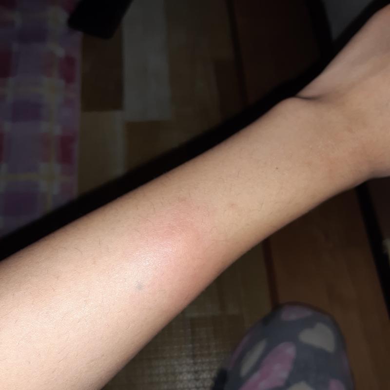 팔이 모기 물린것처럼 부어올랐는데 뭐야..? 아무리 봐도 모기 물린건 아닌같아서