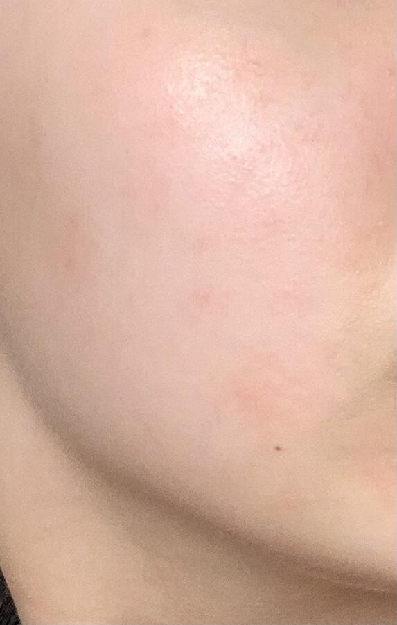 보는 사람이 있을지는 모르겠는데 사진도 올려볼게 지금 상태야.. 이마 왼쪽 볼 오른쪽 볼.. 확실히 볼은>>42 처럼 올록볼록한건 들어갔는데 전
