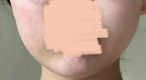 눈두덩이도 좀 빨개보여 사진상으로는 좀 티가 안나나? 그리고 정면에서 보면 피부가 저럼 ㅠㅜㅠㅠ 레더들 나 어떡해 이 피부로 화장했다가는 끝장날