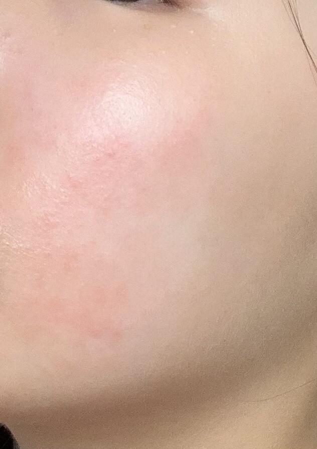 보는 사람이 있을지는 모르겠는데 사진도 올려볼게 지금 상태야.. 이마 왼쪽 볼 오른쪽 볼.. 확실히 볼은>>42 처럼 올록볼록한건 들어갔는데 전