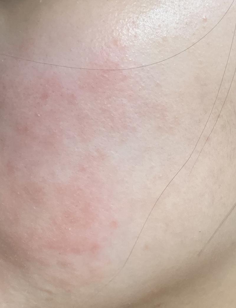 일단 접촉성 피부염이 왼쪽 볼에 생긴거라 이부분만ㅠㅜㅠ 위는 몇주전 내 피부 아래는 어제찍은 내 피부 상태임