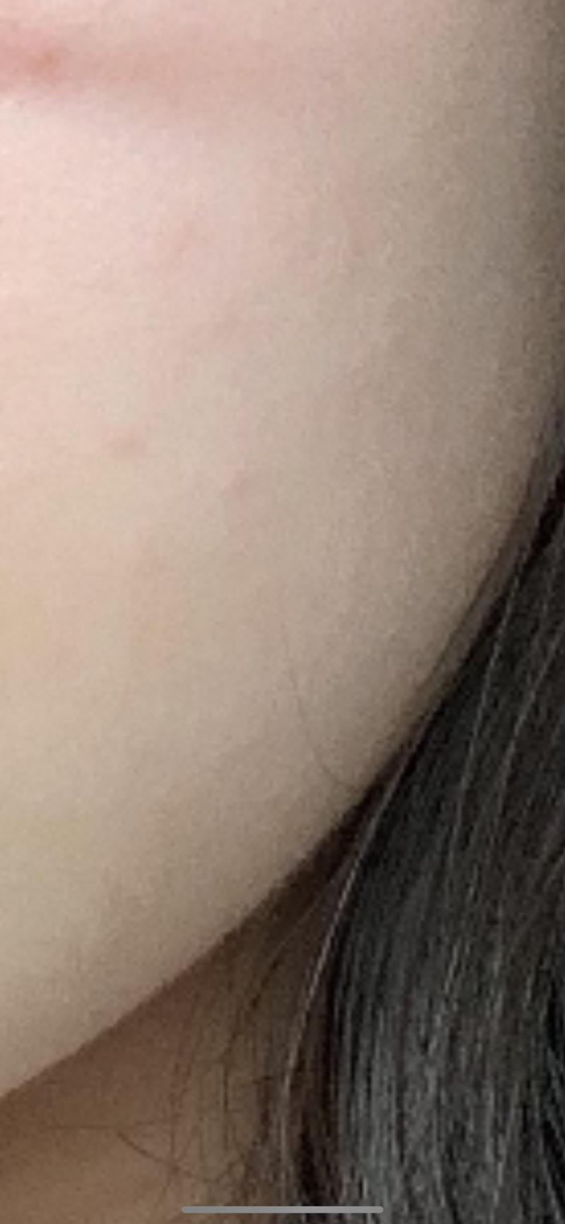 일단 접촉성 피부염이 왼쪽 볼에 생긴거라 이부분만ㅠㅜㅠ 위는 몇주전 내 피부 아래는 어제찍은 내 피부 상태임