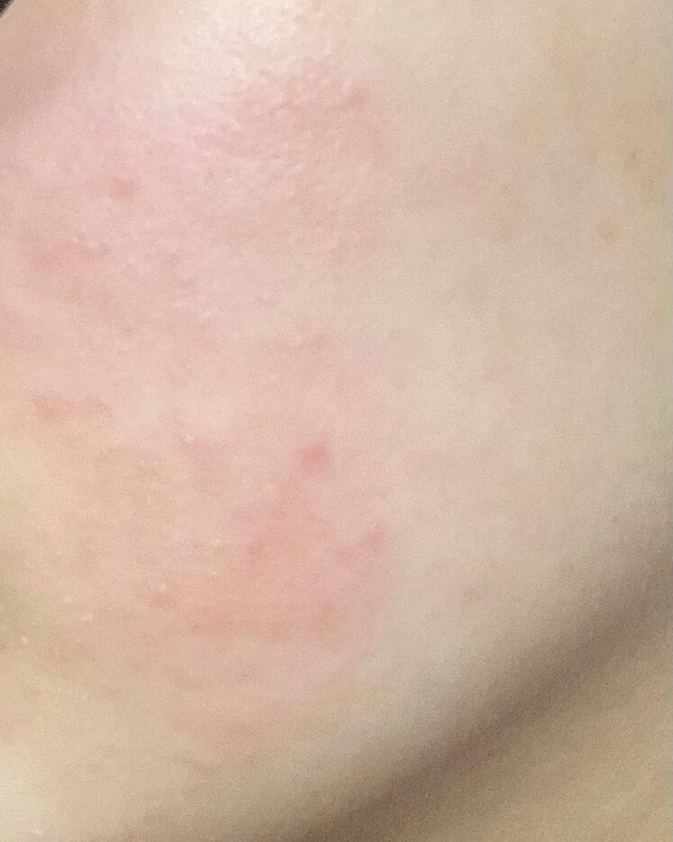 위는 현재 내 오른쪽 볼, 아래는 왼쪽 볼임 의사 쌤이 저 피부염 있는 부분에는 스킨 수분크림 화장 그 어떤것이든 연고 외에는 손도 대지말라고해