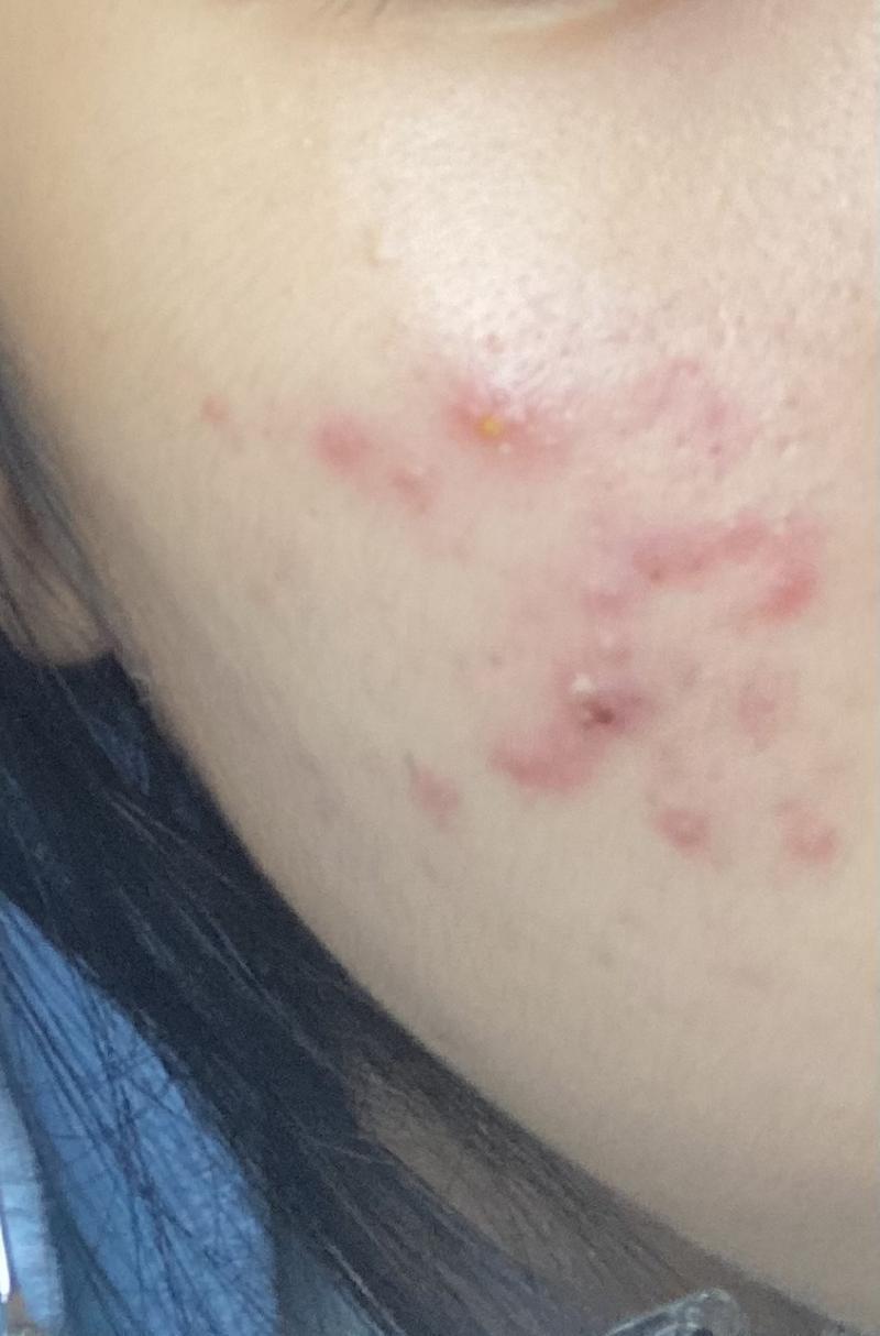 >>2 사진으로 줄게 나도 내가 먼타입인지 모르겠다...빨간게 급나 많아 근데 왼쪽볼은 이렇게 안심해 저번주부터 이러더니 계속 심해져 ㅠ