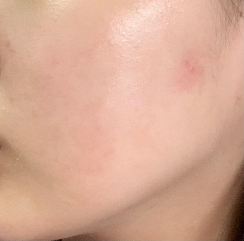 연고 바른지 2일차 친구들도 좀 가라앉았다고 할 정도임 예전엔 헐 빨갛다였으면 홍조로 보일정도로 가라앉았다고하는데 난 잘모르겠당 오른쪽 볼은 그