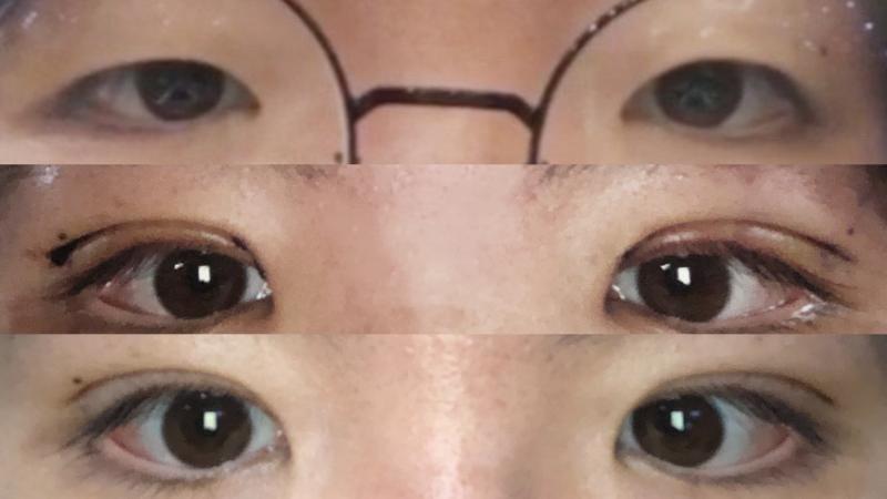 혹시 쌍수같은 거 잘 아는 사람 있어? 나는 평소에 잘 꾸미지도 않았고 항상 안경쓰고 다녔는데 이제 곧 대학생인 만큼 엄마가 쌍커풀 수술해주신다