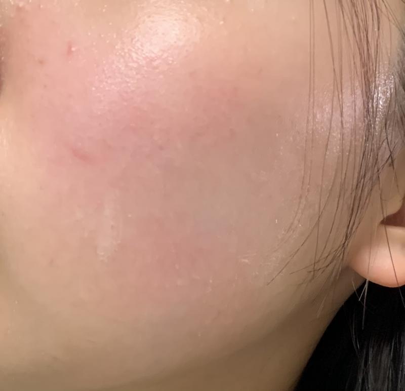지금보니까>>14 도 완전히 나은건아니네ㅠㅜㅠ 아직까지 연고 조금씩 바르는데 오늘 마스크 오래 꼈더니 또 빨개졌다 ㅎㅎㅎㅎ....