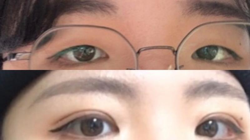 지금 쌍수 이주차인데 붓기 여기서 더 빠지겠지??? 아예 속쌍을 원했어서 지금은 그냥 완전 겉쌍인거 같은디 ㅅㅂ 앞트임 뒷트임 이런거 아예 안해