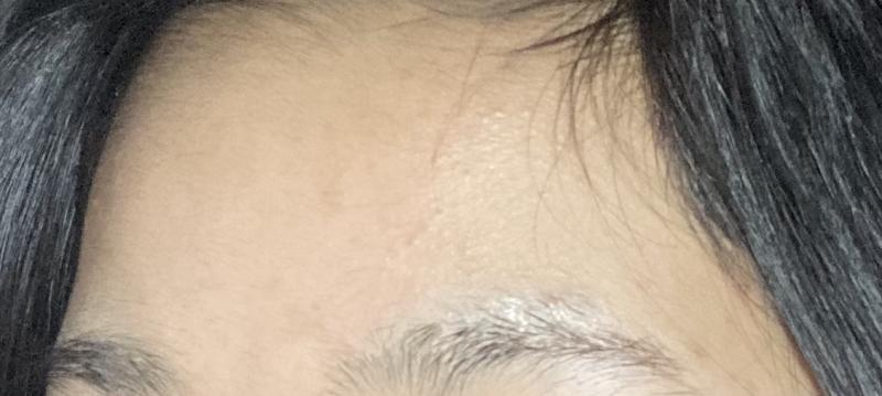 완전히는 아니지만 진짜 ㅇㅖㅅ날 사진보고 찐으로 놀램 .. 지금은 조명받으면 좁쌀 조금 부각되는 정도