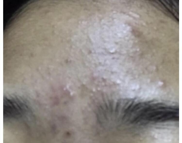 완전히는 아니지만 진짜 ㅇㅖㅅ날 사진보고 찐으로 놀램 .. 지금은 조명받으면 좁쌀 조금 부각되는 정도