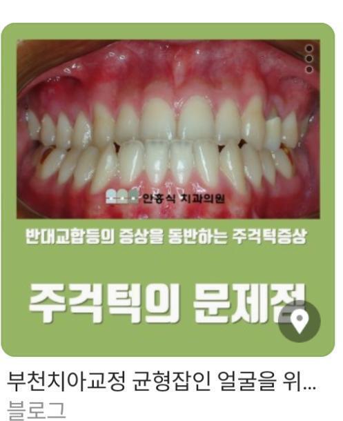 >>13 혹시 이가 이런식으로 맞물려?