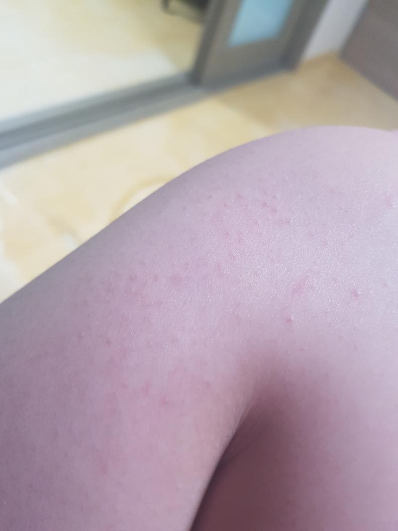 얘두라 이거 두드러기?알레르기?증상이야..? 갑자기 확 올라오네