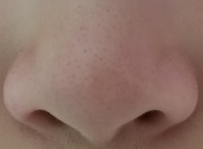 많이는 아닌데 코 밑쪽에 없어졌어ㅠㅠㅠㅠ 카메라 말고 그냥 눈으로 보면 완즌 애기코임... 카메라처럼 많이 부각되지도 않고