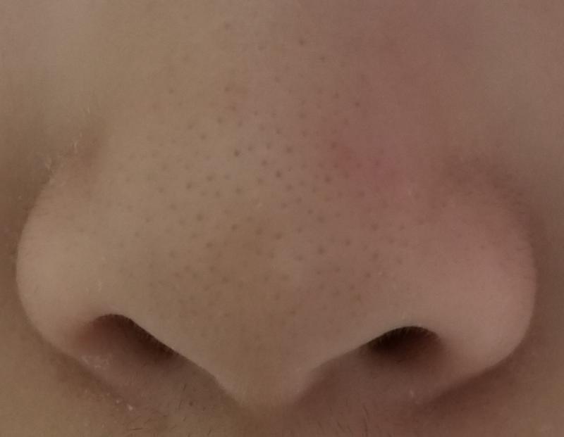 많이는 아닌데 코 밑쪽에 없어졌어ㅠㅠㅠㅠ 카메라 말고 그냥 눈으로 보면 완즌 애기코임... 카메라처럼 많이 부각되지도 않고
