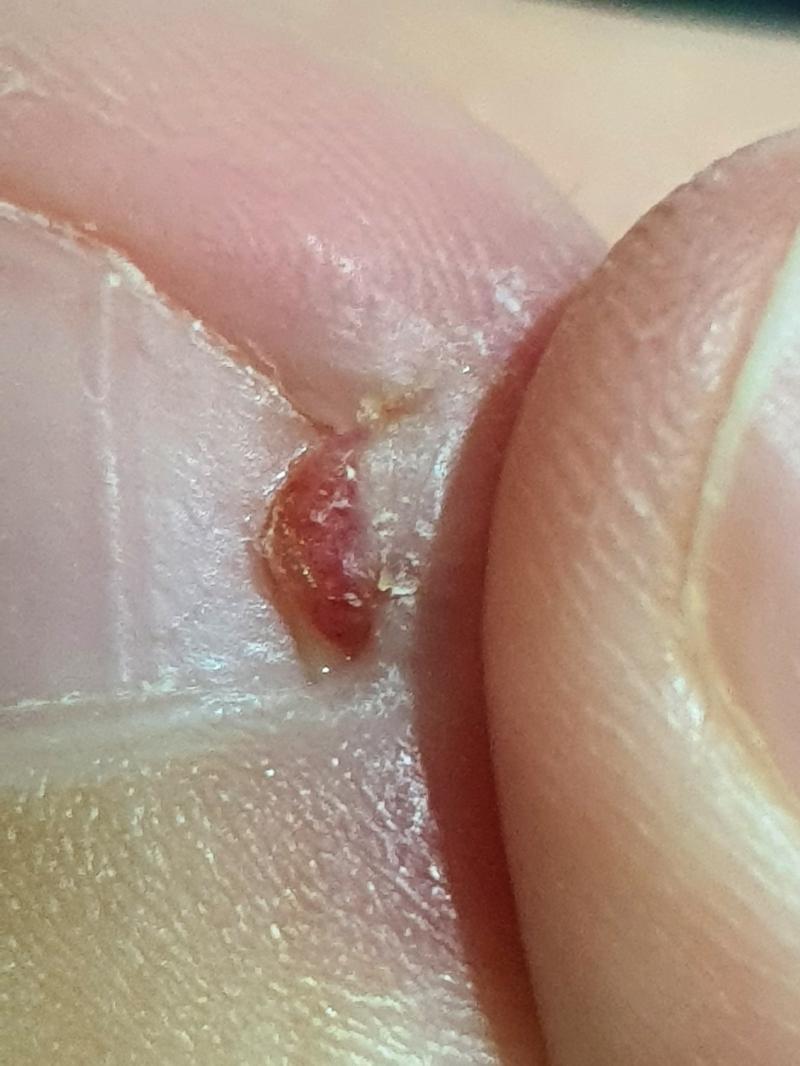 사진 진짜 ㄹㅇ 극극극극혐혐혐혐혐 주의!@!!@!!! 발꾸락에 저런게 났는데 먼지 아는 사람 있어...? 빨간색 저거 ㅇㅇ 잡아 뜯어도 되는거임
