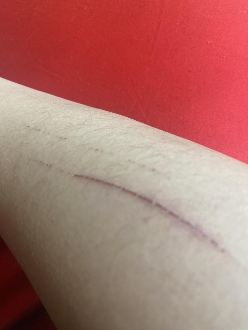 이런 상처가 팔이나 다리 얼굴에 있어ㅜㅜ 제모 안 한 거 이해 해줘 겨울이잖아 ㅎ