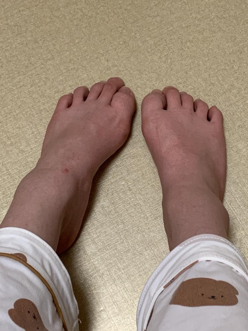 내 피부 안저런데 아이폰일카 왜저러냐.. 발톱정리 못해서 지저분하니까 확대는하지마